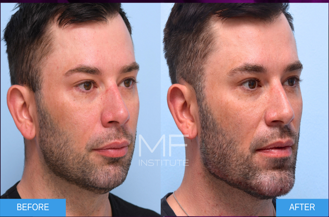 Chin Filler Before and After