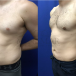 lipo 360 before and after