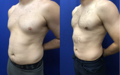 lipo 360 before and after