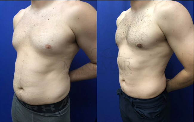 lipo 360 before and after