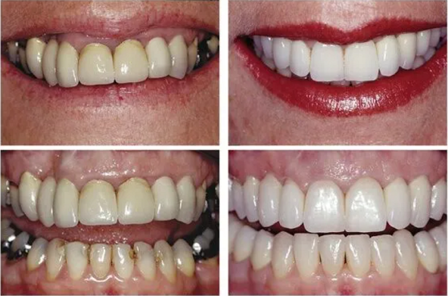 tooth crown before and after